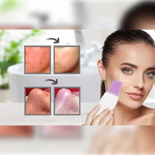 ULTRASONIC SİYAH NOKTA  AKNE SPATULA ŞARJLI CİLT TEMİZLEYİCİ